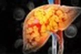 Không chỉ dầu mỡ, 1 loại gia vị nếu lạm dụng có thể khiến gan ‘ngập’ trong mỡ: Nhà ai cũng dùng mỗi ngày