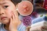 Bé trai 3 tuổi bị sùi mào gà trên mặt, bác sỹ nói do dùng chung khăn tắm