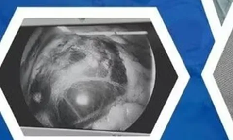 Chỉ đau bụng nhẹ nên chủ quan, người phụ nữ "chết lặng" khi phát hiện thai lạc chỗ ở vị trí cực kỳ nguy hiểm