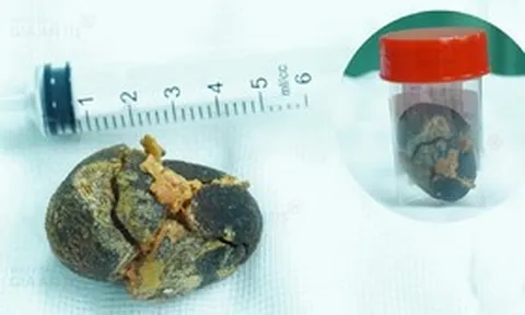 Đi khám sức khỏe định kỳ, người phụ nữ "sốc" khi phát hiện điều bất ngờ