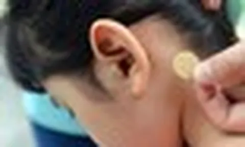 Bé gái 7 tuổi loạn thần, sốt cao sau khi sử dụng miếng dán chống say tàu xe: Bác sĩ cảnh báo sai lầm nguy hiểm bố mẹ mắc phải