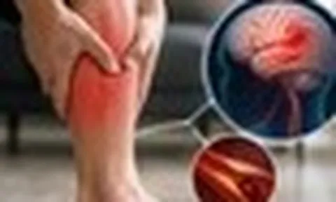 Chuyên gia cảnh báo: 5 dấu hiệu tại BẮP CHÂN có thể là tín hiệu cảnh báo đột quỵ, nếu thấy phải đi kiểm tra ngay