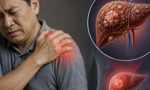 Cảnh báo 1 TÍN HIỆU cực quan trọng của ung thư gan: Nhiều người còn cố cãi chỉ đau vai thông thường