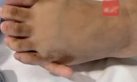 Cô gái 17 tuổi có 6 ngón tay "mọc" ra và sự thật bất ngờ