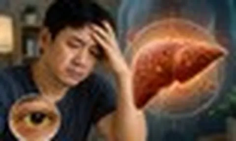 Bác sĩ cảnh báo: 5 DẤU HIỆU ở mắt cho thấy gan đang có vấn đề, nhiều người lại tưởng do thay đổi thời tiết