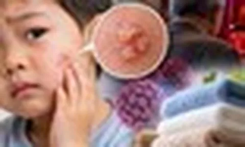 Bé trai 3 tuổi bị sùi mào gà trên mặt, bác sỹ nói do dùng chung khăn tắm