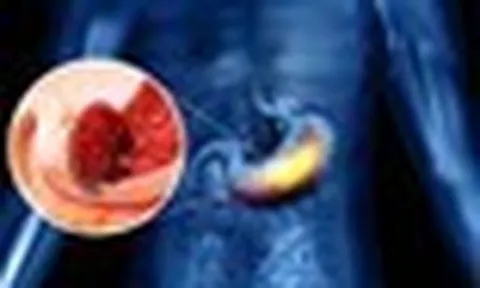 Không chỉ rượu bia, ung thư dạ dày thường "để mắt” tới những người thường xuyên sử dụng loại đồ uống này