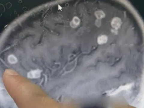 Bé gái sốt liên tục 17 ngày, bác sĩ sốc nặng khi phát hiện "bí mật" đáng sợ