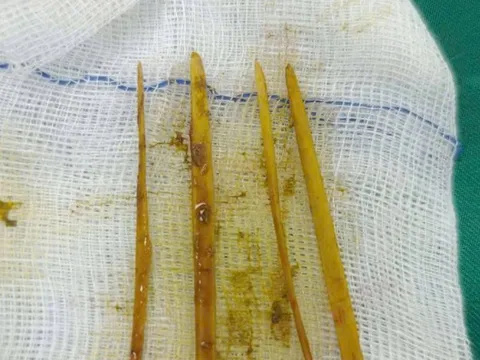 Cô gái 26 tuổi đau bụng dữ dội, bác sĩ “chết lặng” khi phát hiện thứ bên trong