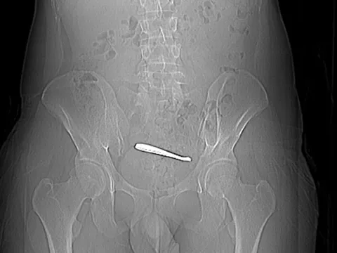 Người đàn ông đau bụng suốt 1 tuần, bác sĩ kiểm tra thì sốc nặng