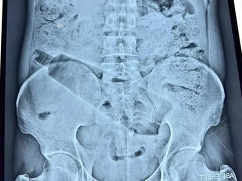 Người đàn ông đau bụng 36 tiếng, bác sĩ phát hiện "bí mật" bên trong