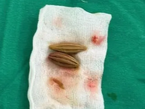 Nuốt nhầm hạt nhót, cụ bà nguy kịch