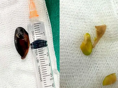 Bé 14 tuổi ho khan kéo dài, gia đình sốc khi bác sĩ lấy ra dị vật bên trong cơ thể