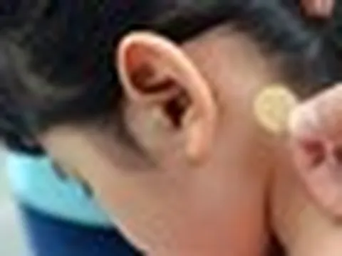 Bé gái 7 tuổi loạn thần, sốt cao sau khi sử dụng miếng dán chống say tàu xe: Bác sĩ cảnh báo sai lầm nguy hiểm bố mẹ mắc phải