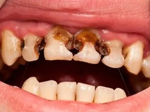 Trẻ thiếu canxi thường phát ra 5 tín hiệu: Bệnh viện Nhi đồng 2 cảnh báo đừng chủ quan