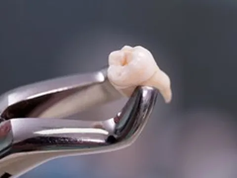 Đi nhổ răng khôn, cụ bà 83 tuổi suýt tử vong