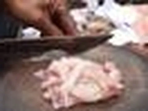 Người đàn ông mắt phải teo nhỏ suốt 12 năm, bác sĩ mổ tủy sống phát hiện "thủ phạm" là thói quen vạn người mê