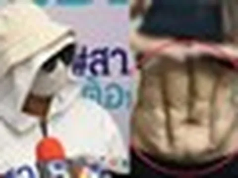 Phần bụng biến dạng của người phụ nữ sau ca phẫu thuật "cơ bụng số 11" giá rẻ tại phòng khám nổi tiếng Thái Lan