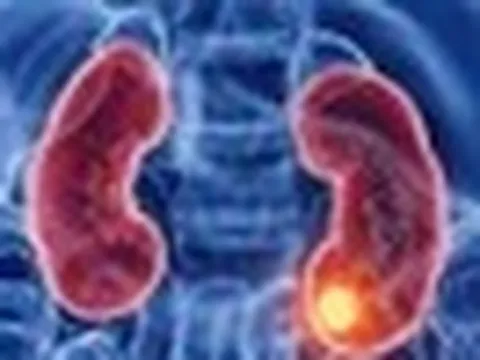 Thận đã bị tổn thương dù chưa có triệu chứng: "Thủ phạm" là 6 thói quen nhiều người vẫn làm mỗi ngày