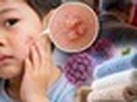 Bé trai 3 tuổi bị sùi mào gà trên mặt, bác sỹ nói do dùng chung khăn tắm