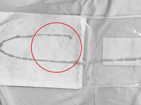 Người phụ nữ 48 tuổi sốc khi bác sĩ gắp ra thứ "đáng sợ" bên trong bụng