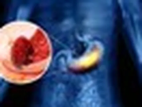 Không chỉ rượu bia, ung thư dạ dày thường "để mắt” tới những người thường xuyên sử dụng loại đồ uống này