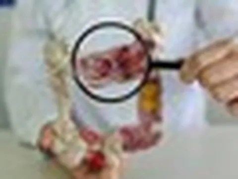 Ung thư đại tràng thường "để ý" những người có 2 đặc điểm này: Nếu có cần hành động ngay!